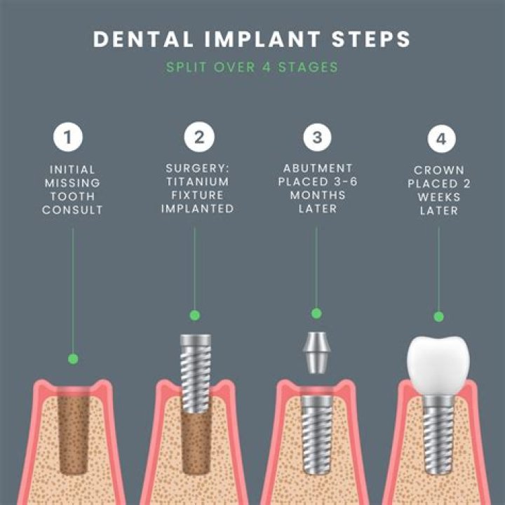 Does Medicaid in North Carolina Cover Dental Implants - Everything You Need to Know