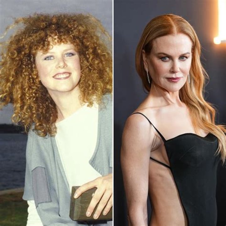 Nicole Kidman: The Debate Over Too Much Filler