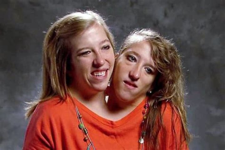 Now Abby and Brittany Hensel: The Unique Journey of Conjoined Twins