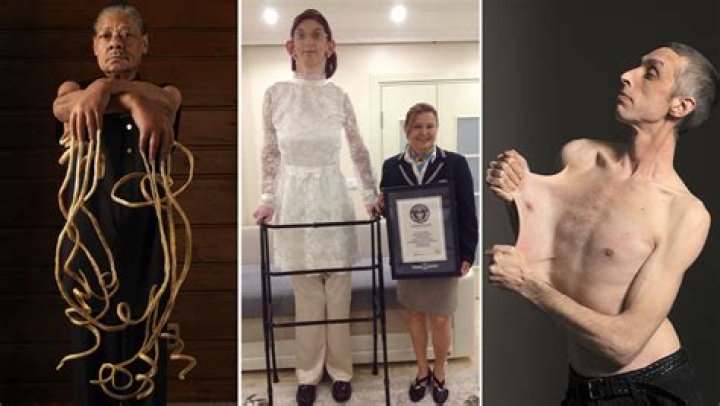 Who is the Most Skinniest Person in the World? Unveiling the Truth Behind Extreme Thinness